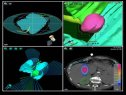 La nueva radioterapia | Recurso educativo 54992